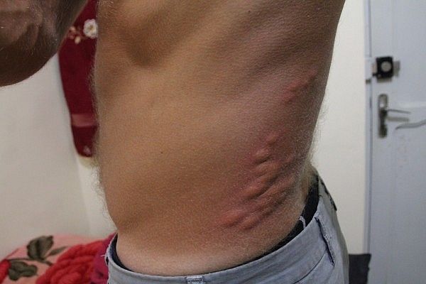 Bed bug bites